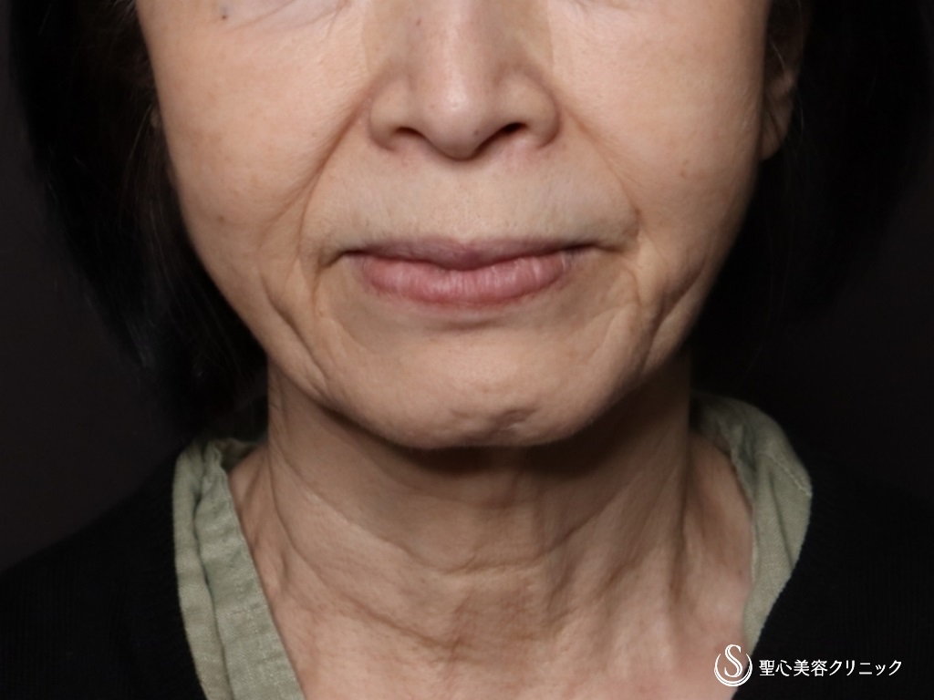 プレミアムミニリフト＋ネックリフト＋脂肪吸引注射（頬顎下）_Before