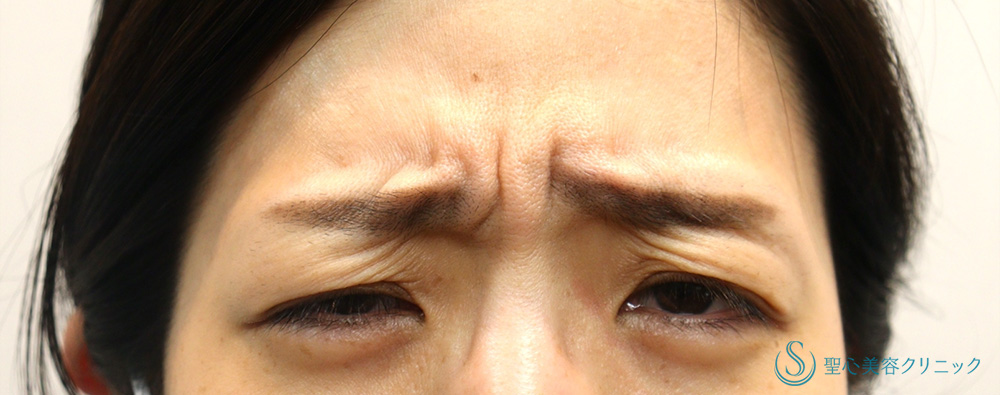 眉間ボツリヌストキシン注入（注射）_Before