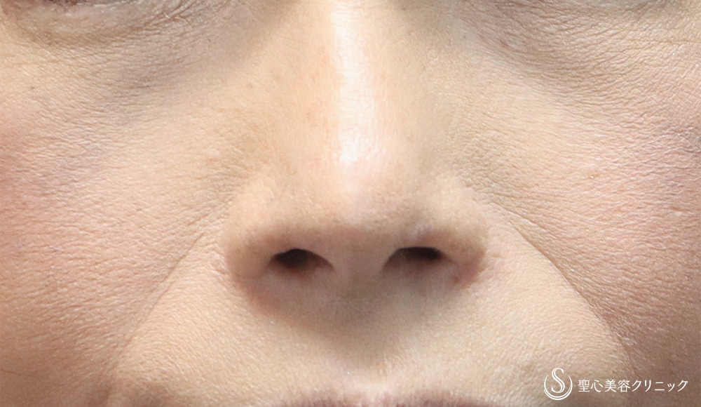 鼻孔縁下降術_After
