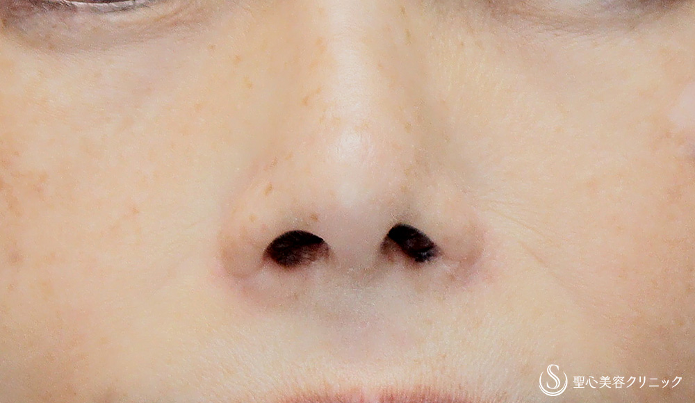 鼻孔縁下降術_Before