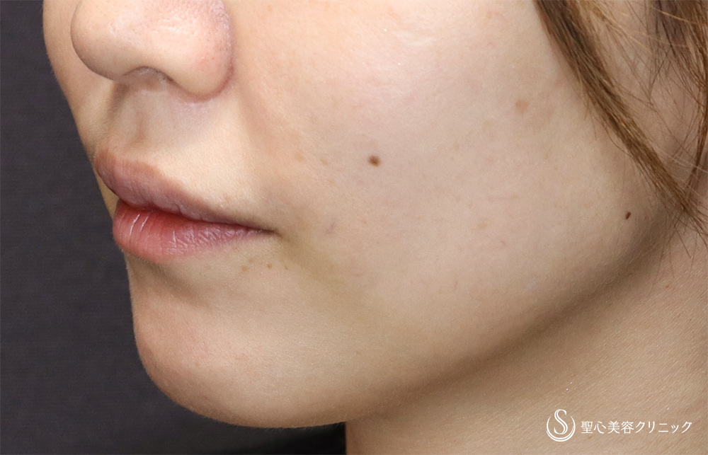 鼻下短縮術（人中短縮・リップリフト）_After