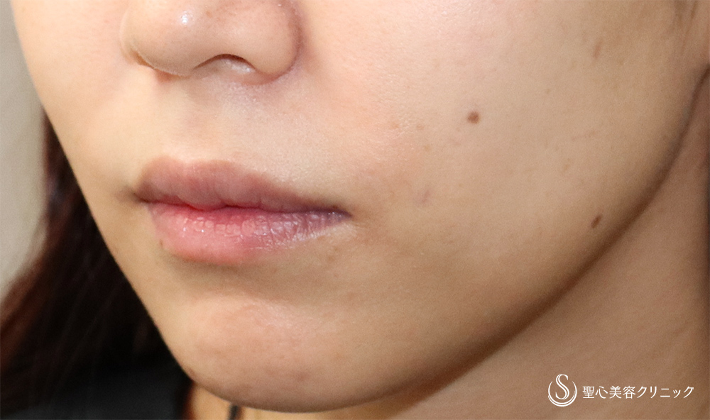 鼻下短縮術（人中短縮・リップリフト）_Before