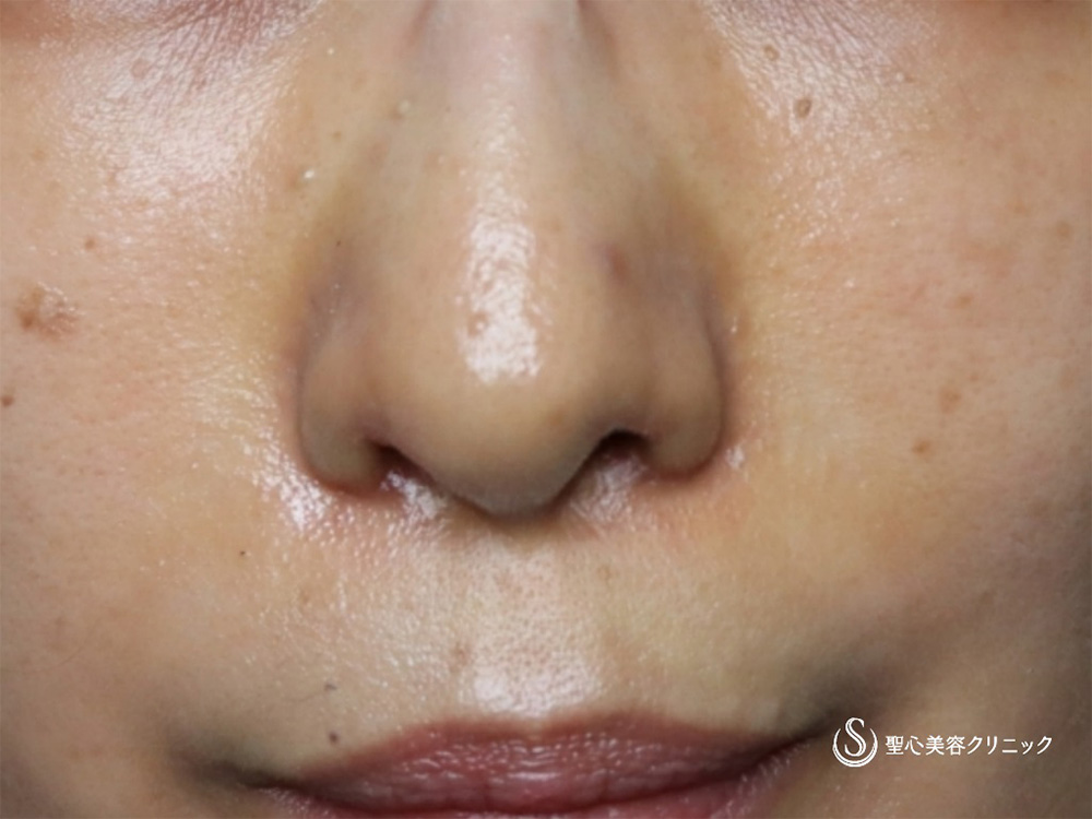 小鼻縮小（内側法）＋鼻孔縁下降術_After