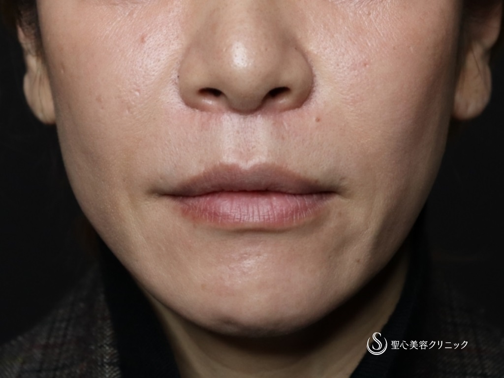リップリフト（人中短縮術）_After