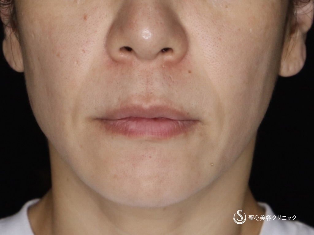 リップリフト（人中短縮術）_Before