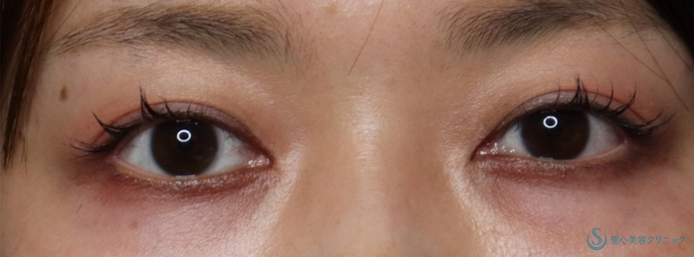 目頭切開/目上切開_After