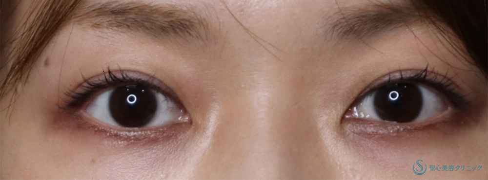 目頭切開/目上切開_Before