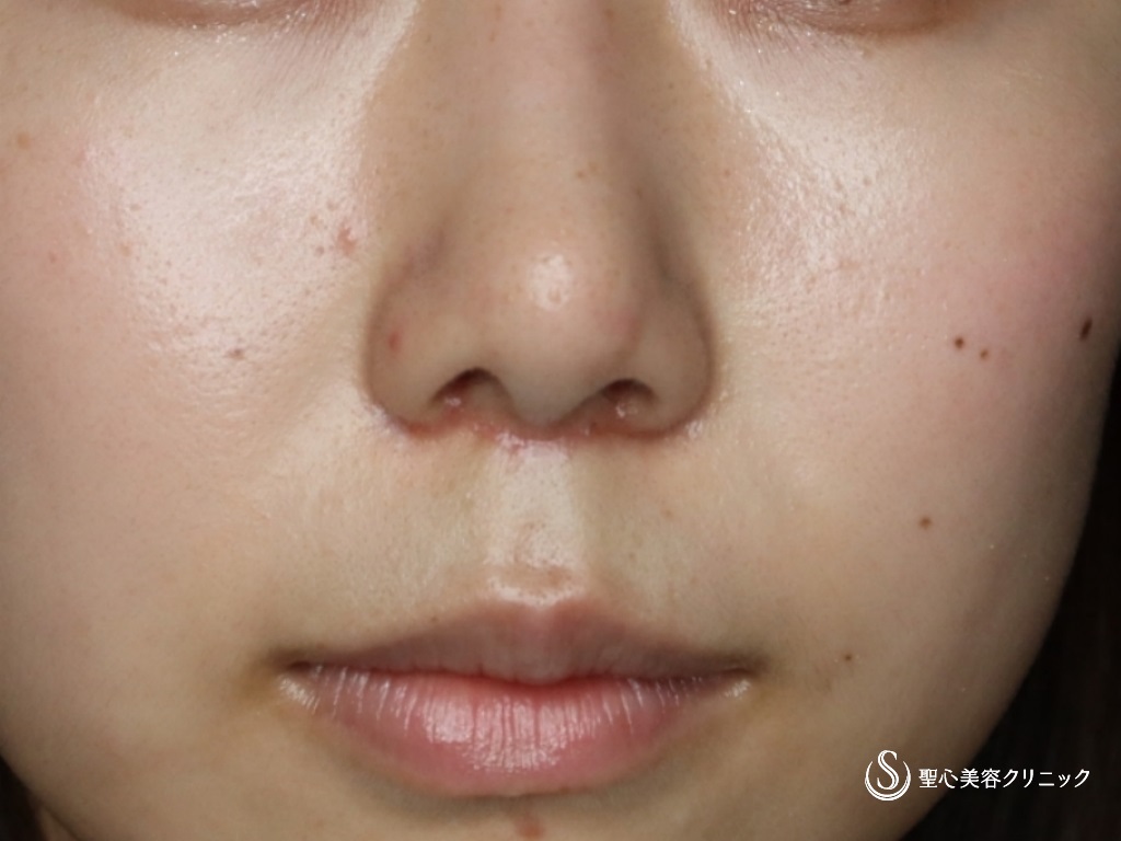鼻尖形成（耳介軟骨移植）＋鼻尖縮小＋リップリフト_After
