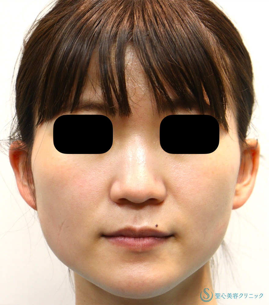 ボツリヌストキシン注入（注射）_Before