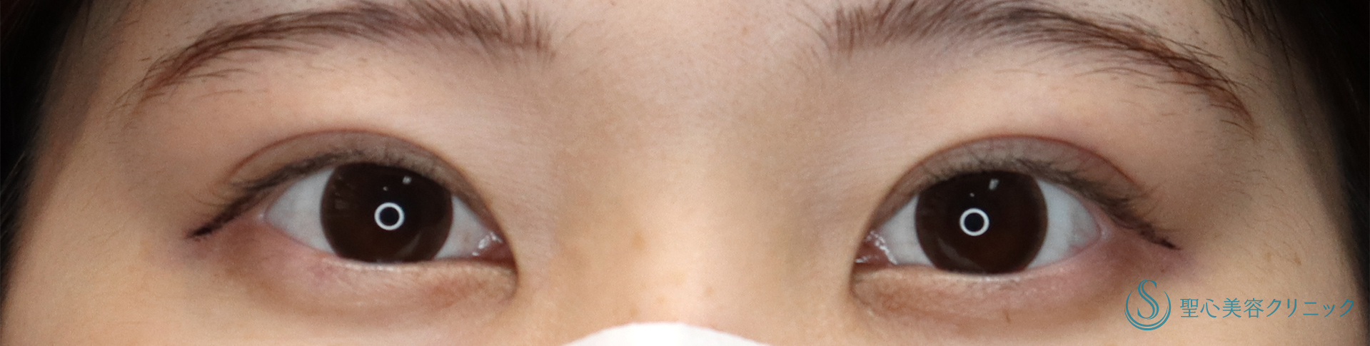 二重マイクロメソッド埋没法（3点留め）_After