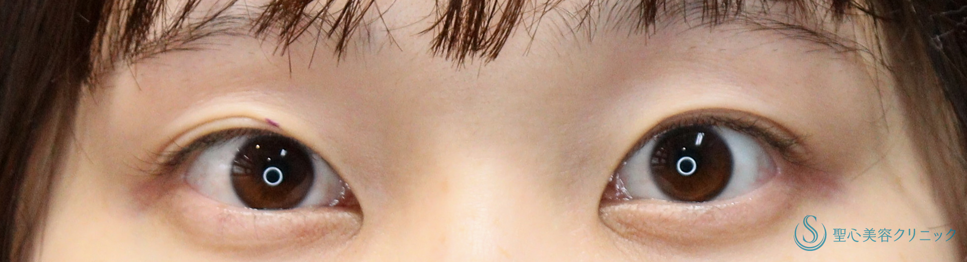 二重マイクロメソッド埋没法（3点留め）_Before